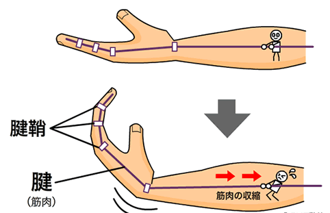 腱鞘炎