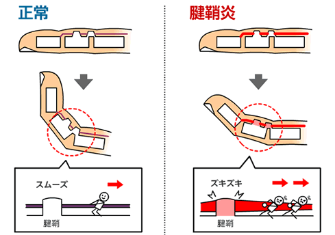 腱鞘炎